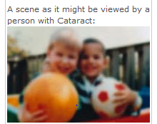 cataracts